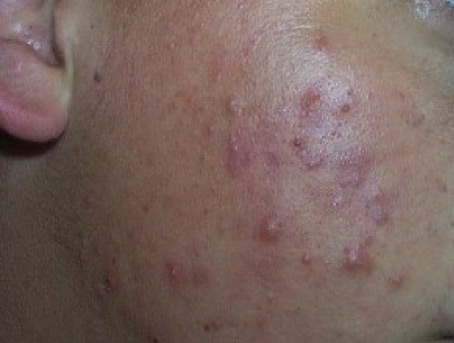 faces with acne vulgaris