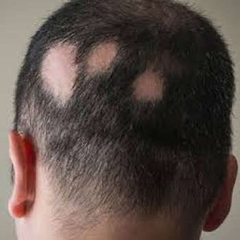 alopecia areata