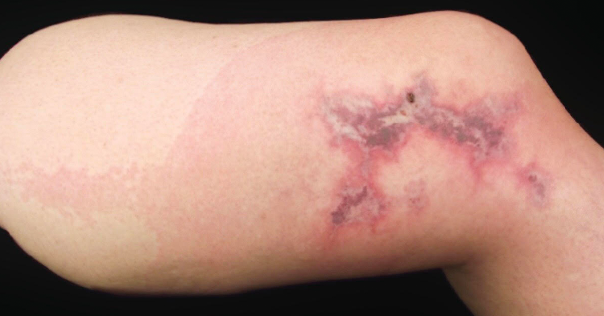 Spider Bites - American Osteopathic College of Dermatology (AOCD)