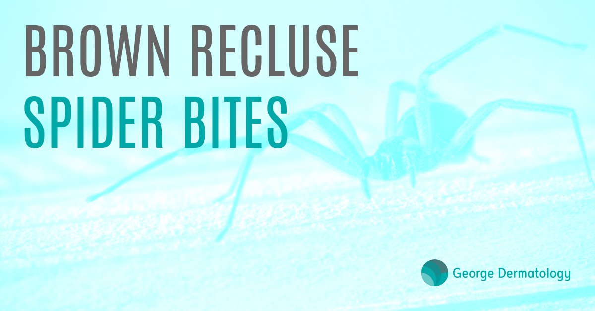 Brown recluse spider bites.