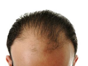 hair loss