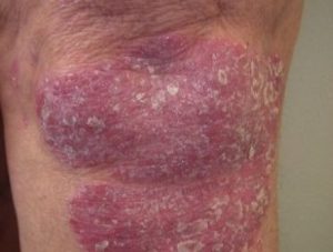 psoriasis