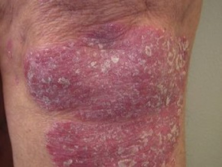 bioptron kezelése pikkelysömörhöz pikkelysömör kezelése népi gyógymódokkal otthon vélemények
