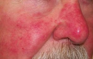 rosacea
