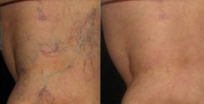 spider veins before and after